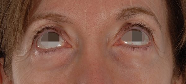 Eye lift Case 3138 Before Photo Eye lift