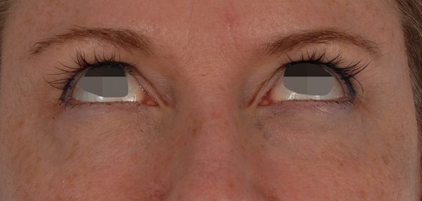 Eye lift