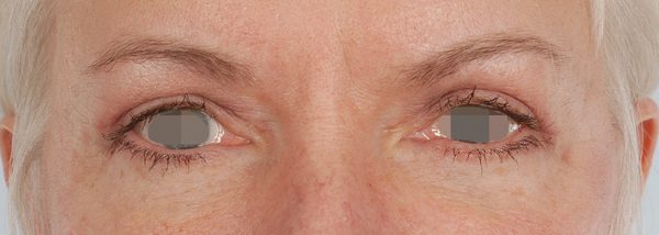 Eye lift