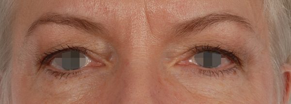 Eye lift