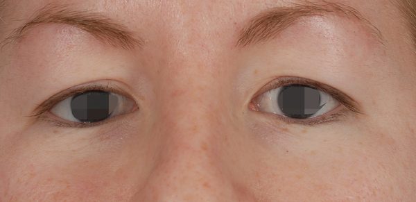 Eye lift