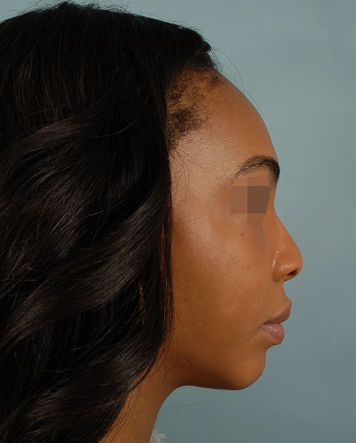 Asymmetry and Facial Reshaping