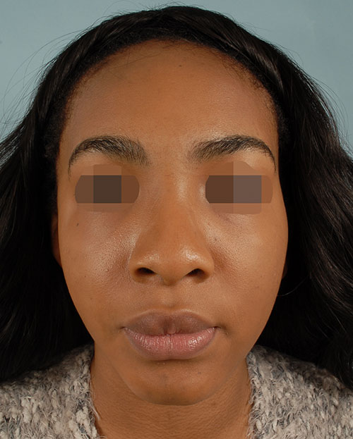 Asymmetry and Facial Reshaping