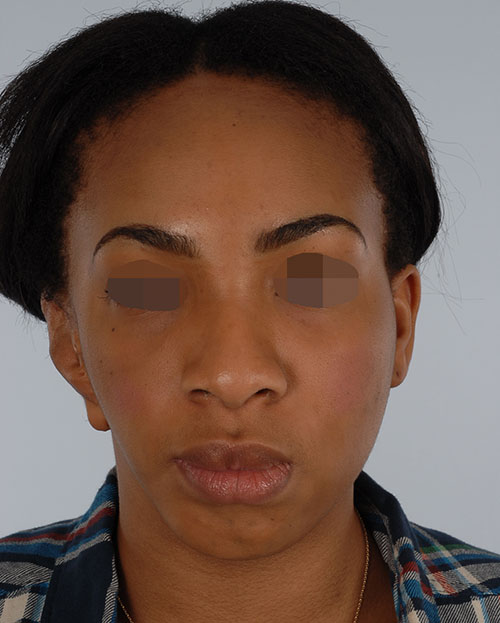 Asymmetry and Facial Reshaping