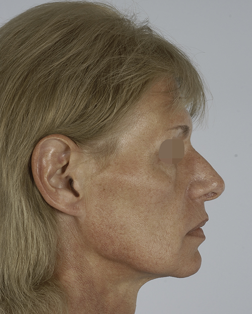 Asymmetry and Facial Reshaping Case 3215 Before Photo Asymmetry and Facial Reshaping