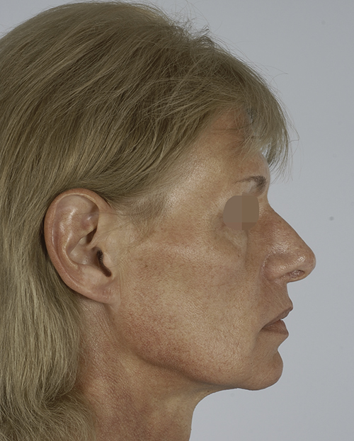 Asymmetry and Facial Reshaping