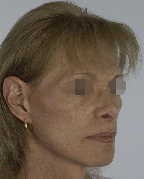 Asymmetry and Facial Reshaping Case 3215 After Photo Asymmetry and Facial Reshaping