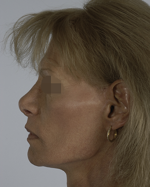 Asymmetry and Facial Reshaping Case 3215 After Photo Asymmetry and Facial Reshaping