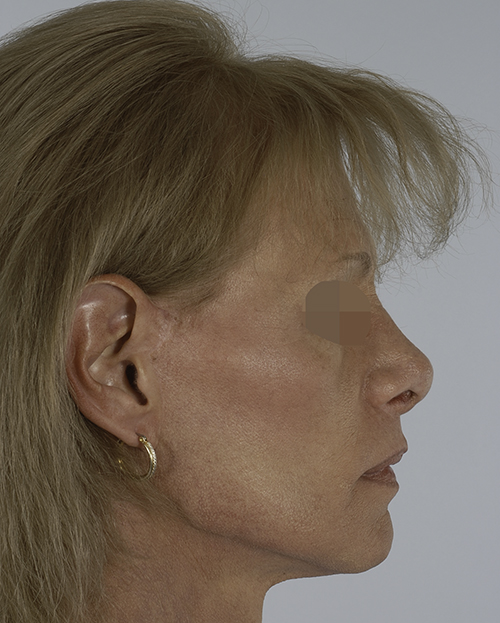 Asymmetry and Facial Reshaping Case 3215 After Photo Asymmetry and Facial Reshaping