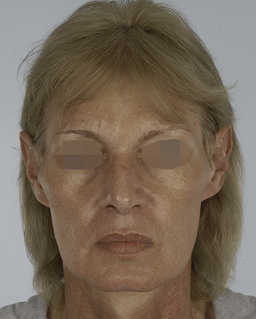 Asymmetry and Facial Reshaping Case 3215 Before Photo Asymmetry and Facial Reshaping