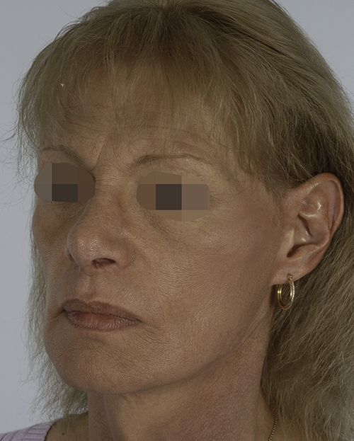 Asymmetry and Facial Reshaping Case 3215 After Photo Asymmetry and Facial Reshaping
