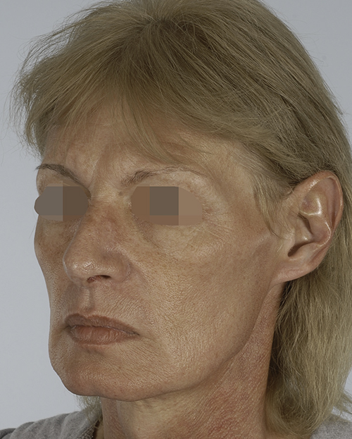 Asymmetry and Facial Reshaping Case 3215 Before Photo Asymmetry and Facial Reshaping
