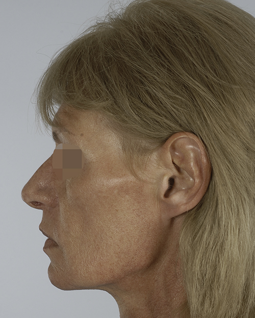 Asymmetry and Facial Reshaping Case 3215 Before Photo Asymmetry and Facial Reshaping