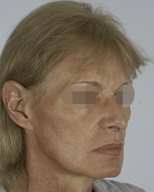 Asymmetry and Facial Reshaping Case 3215 Before Photo Asymmetry and Facial Reshaping