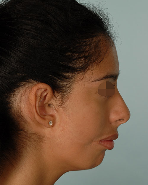 Asymmetry and Facial Reshaping