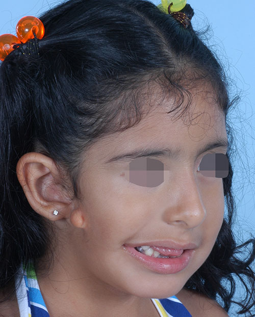 Asymmetry and Facial Reshaping Case 3216 Before Photo Asymmetry and Facial Reshaping