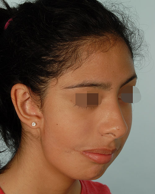 Asymmetry and Facial Reshaping Case 3216 After Photo Asymmetry and Facial Reshaping
