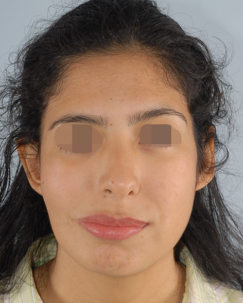 Asymmetry and Facial Reshaping Case 3216 After Photo Asymmetry and Facial Reshaping