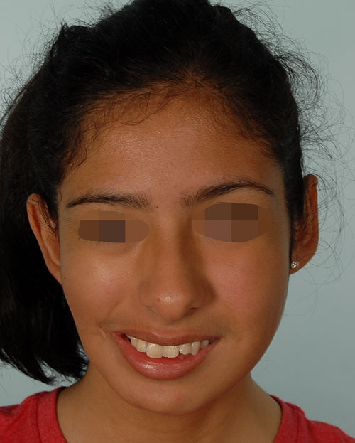 Asymmetry and Facial Reshaping Case 3216 Before Photo Asymmetry and Facial Reshaping