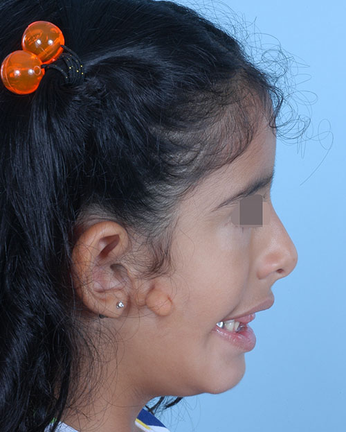 Asymmetry and Facial Reshaping Case 3216 Before Photo Asymmetry and Facial Reshaping
