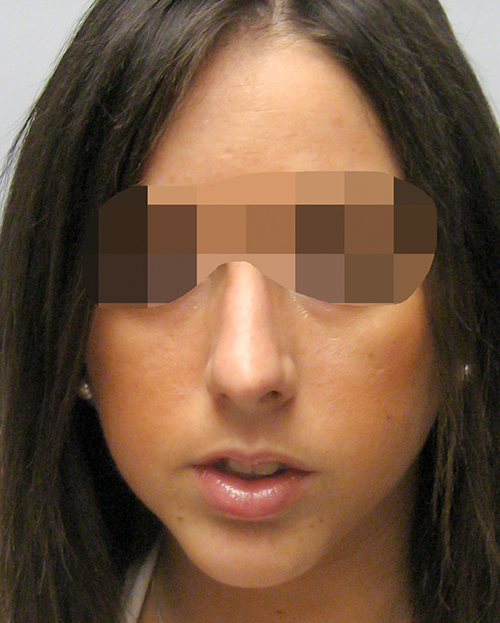 Asymmetry and Facial Reshaping Case 3217 After Photo Asymmetry and Facial Reshaping