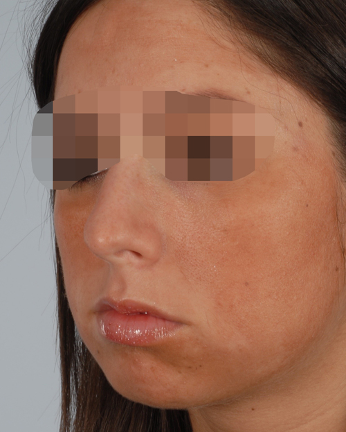 Asymmetry and Facial Reshaping Case 3217 Before Photo Asymmetry and Facial Reshaping