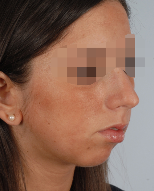 Asymmetry and Facial Reshaping Case 3217 Before Photo Asymmetry and Facial Reshaping