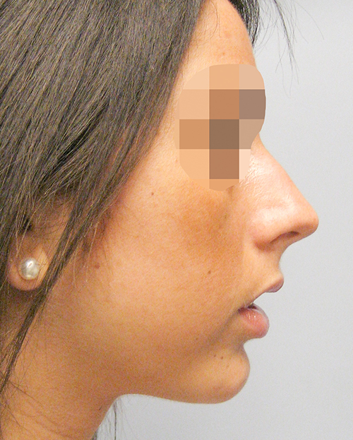 Asymmetry and Facial Reshaping Case 3217 After Photo Asymmetry and Facial Reshaping