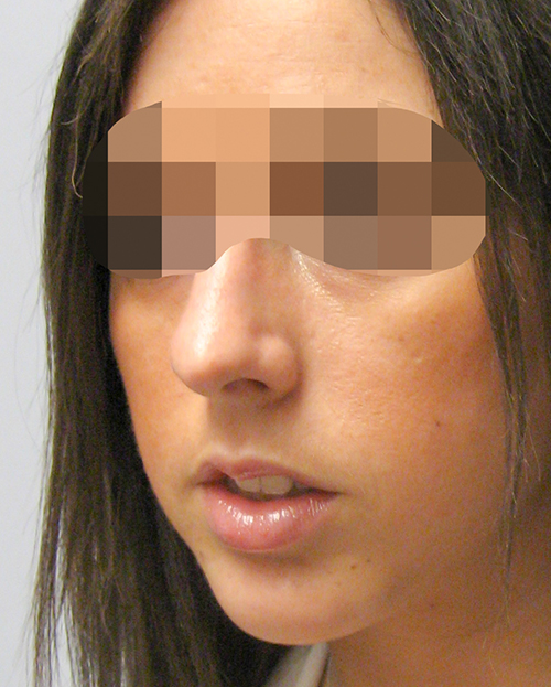 Asymmetry and Facial Reshaping Case 3217 After Photo Asymmetry and Facial Reshaping