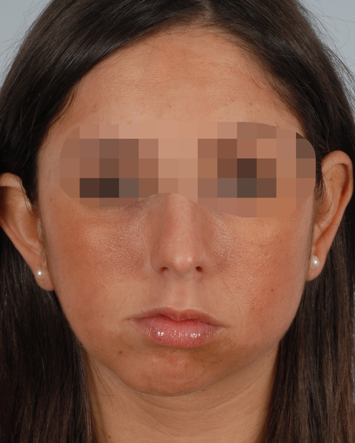 Asymmetry and Facial Reshaping Case 3217 Before Photo Asymmetry and Facial Reshaping