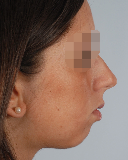 Asymmetry and Facial Reshaping Case 3217 Before Photo Asymmetry and Facial Reshaping
