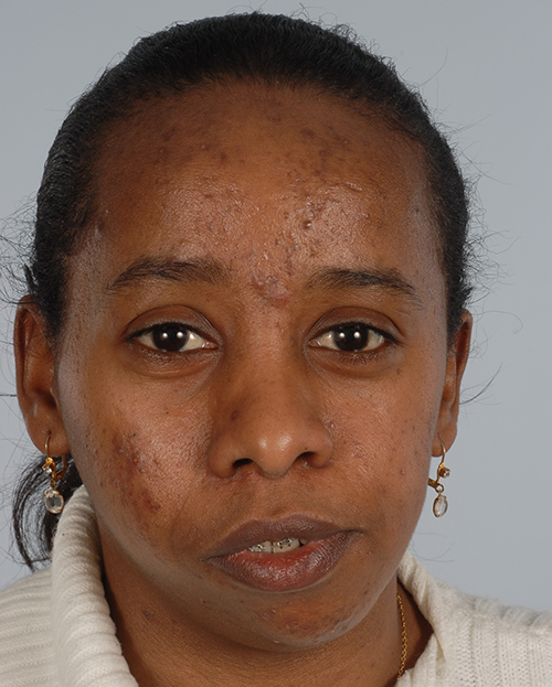 Asymmetry and Facial Reshaping Case 3218 Before Photo Asymmetry and Facial Reshaping