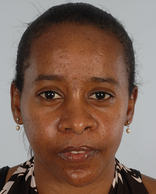 Asymmetry and Facial Reshaping Case 3218 After Photo Asymmetry and Facial Reshaping