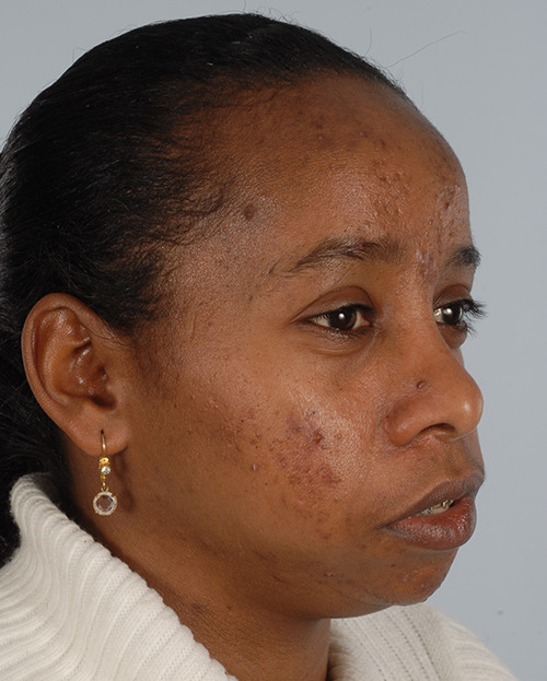 Asymmetry and Facial Reshaping Case 3218 Before Photo Asymmetry and Facial Reshaping
