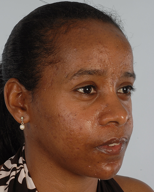 Asymmetry and Facial Reshaping Case 3218 After Photo Asymmetry and Facial Reshaping