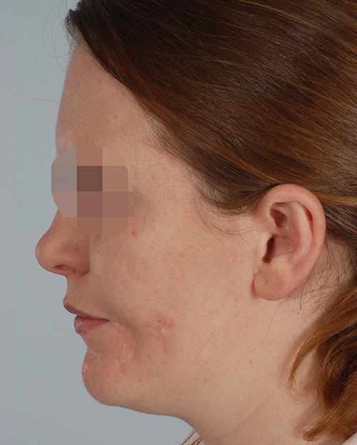 Asymmetry and Facial Reshaping Case 3219 Before Photo Asymmetry and Facial Reshaping