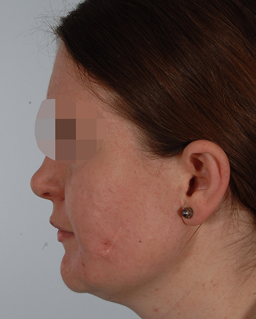Asymmetry and Facial Reshaping Case 3219 After Photo Asymmetry and Facial Reshaping