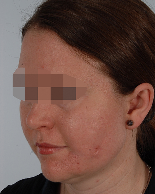 Asymmetry and Facial Reshaping Case 3219 After Photo Asymmetry and Facial Reshaping