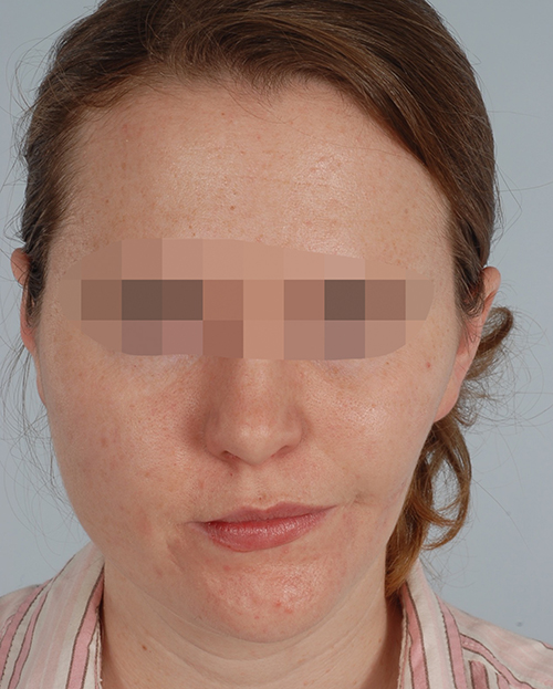 Asymmetry and Facial Reshaping Case 3219 Before Photo Asymmetry and Facial Reshaping