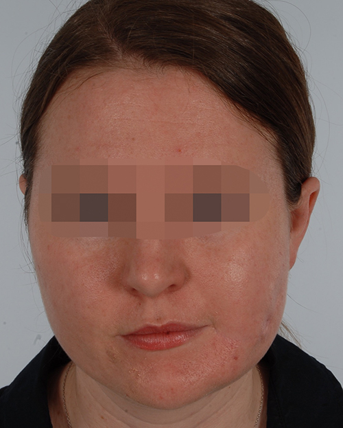 Asymmetry and Facial Reshaping