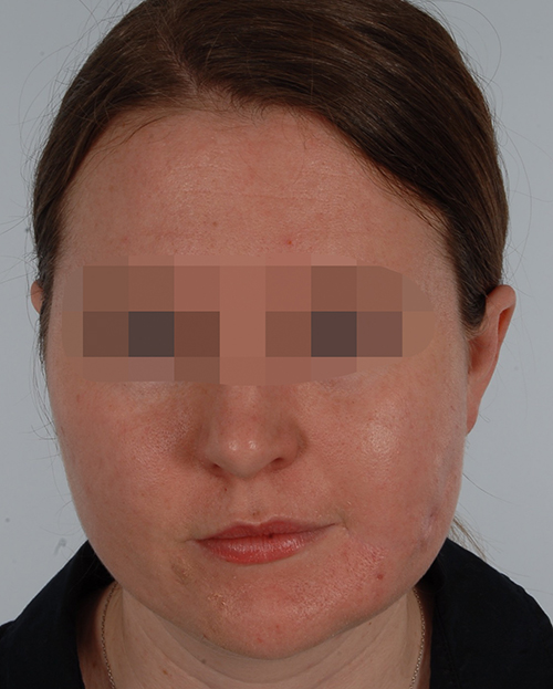 Asymmetry and Facial Reshaping Case 3219 After Photo Asymmetry and Facial Reshaping