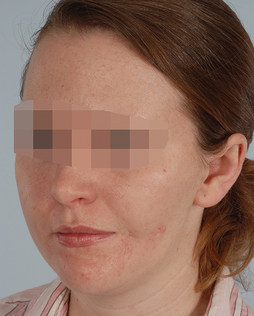 Asymmetry and Facial Reshaping Case 3219 Before Photo Asymmetry and Facial Reshaping