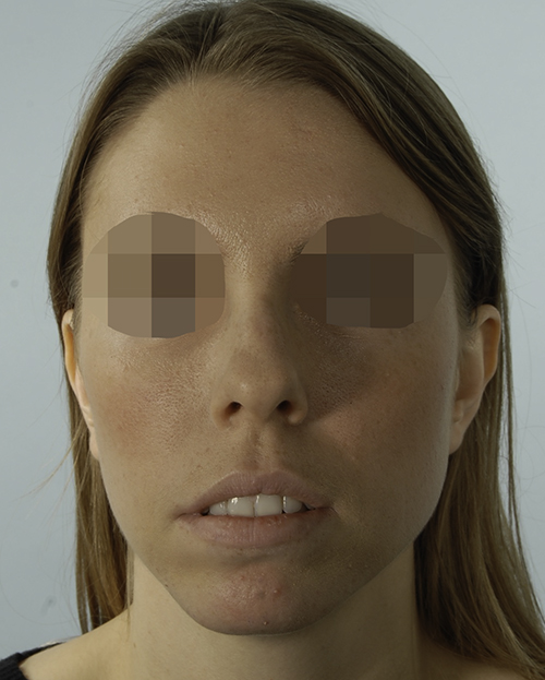 Asymmetry and Facial Reshaping Case 3220 Before Photo Asymmetry and Facial Reshaping
