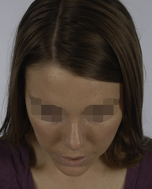 Asymmetry and Facial Reshaping Case 3220 After Photo Asymmetry and Facial Reshaping