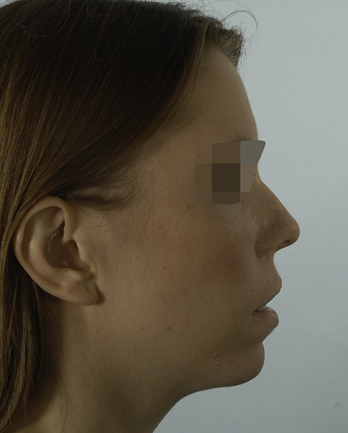 Asymmetry and Facial Reshaping Case 3220 Before Photo Asymmetry and Facial Reshaping