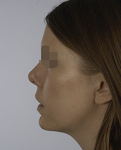 Asymmetry and Facial Reshaping Case 3220 After Photo Asymmetry and Facial Reshaping