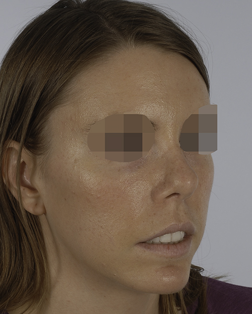 Asymmetry and Facial Reshaping Case 3220 After Photo Asymmetry and Facial Reshaping