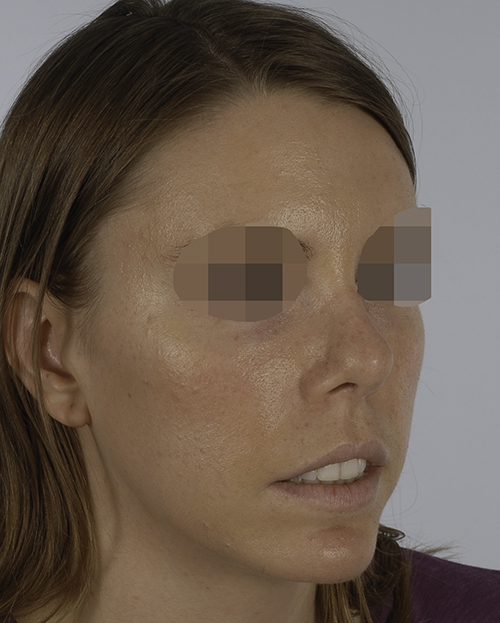 Asymmetry and Facial Reshaping