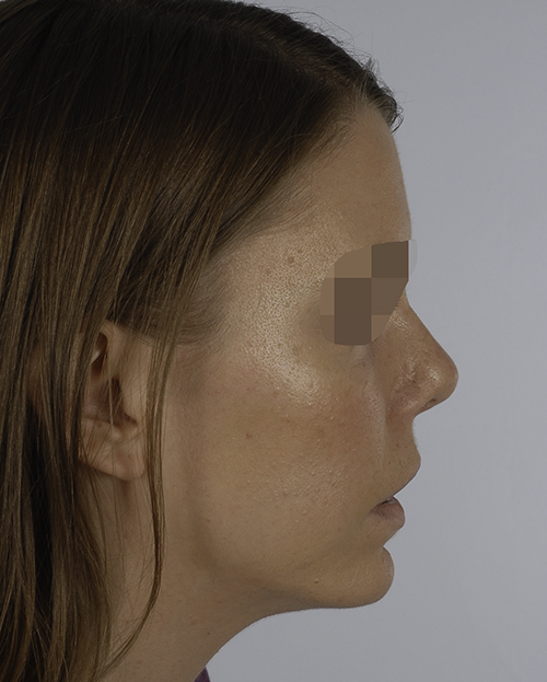 Asymmetry and Facial Reshaping Case 3220 After Photo Asymmetry and Facial Reshaping