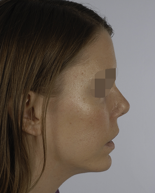 Asymmetry and Facial Reshaping